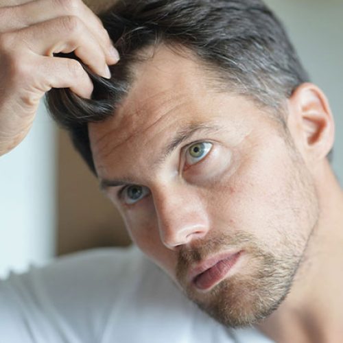 Male Hair Loss Mobile_